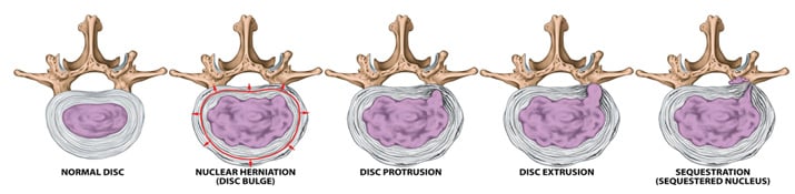 stages of a herniated disc