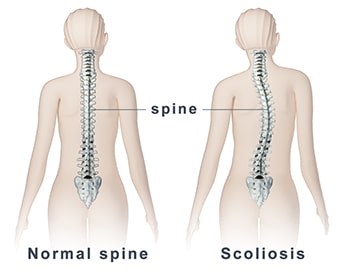 scolisosis vs normal curve of spine