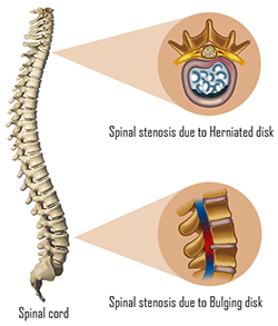 spinal stenosis causes