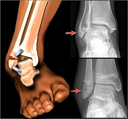 ankle fracture treatment
