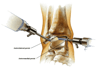 ankle arthroscopy procedure