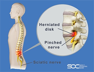 pinched nerve treatment in broward and palm beach