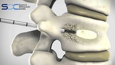 balloon kyphoplasty broward palm beach