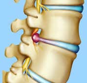 disc herniation pressing nerve