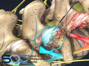 face joint injections in south florida