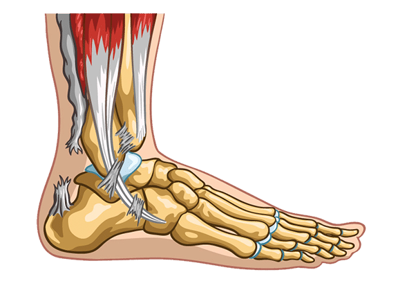 Achilles Tendon rupture treatment in south florida