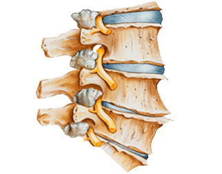 Degenerative-Disc-Disease
