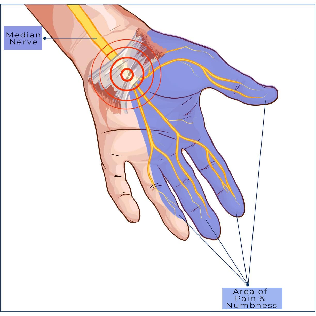 Carpal-Tunnel