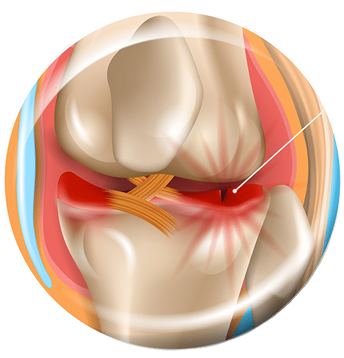 Torn-Meniscus-tear