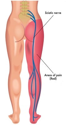 sciatica radiculopathy lumbar