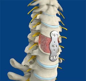anterior cervical corpectomy with fusion