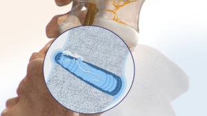 Endplate graphic