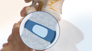 Normal Disc graphic