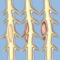 spinal tumors