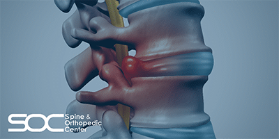 herniated disc symptoms and causes