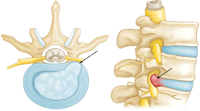 herniated disc causes and symptoms