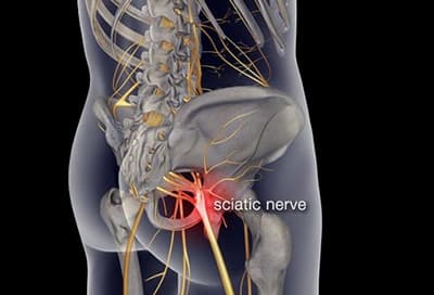 Sciatica - Sciatic Nerve Pain Cause | Spine & Orthopedic ...