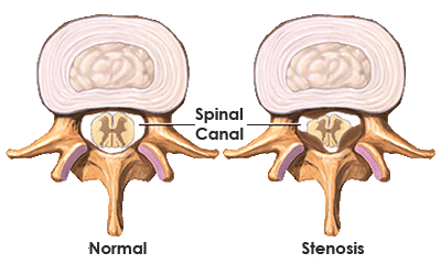 spinal stenosis symptoms and cause