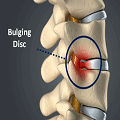 bulging disc
