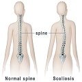scoliosis signs