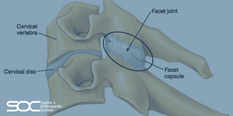 Facet Joint Syndrome | Facet Disease | Spine & Orthopedic Center