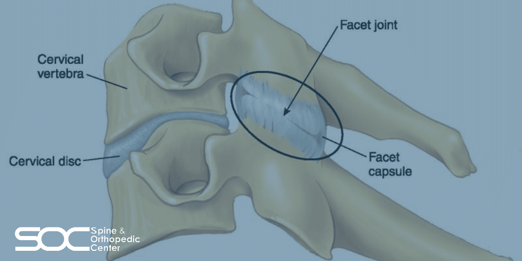 Facet Joint Syndrome Facet Disease Spine And Orthopedic Center