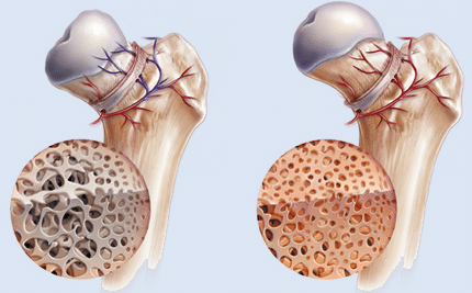 osteonecrosis treatment in south florida