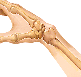 Wrist-Fracture