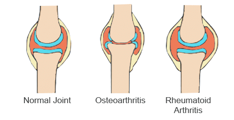 Different-Types-Arthritis