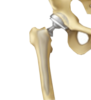 Hip-Replacement