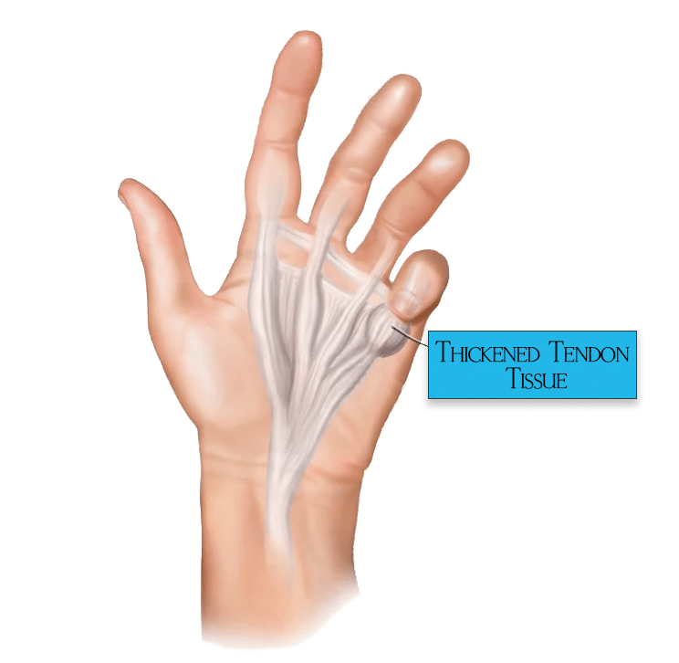 Dupuytrens-Contracture-Disease-