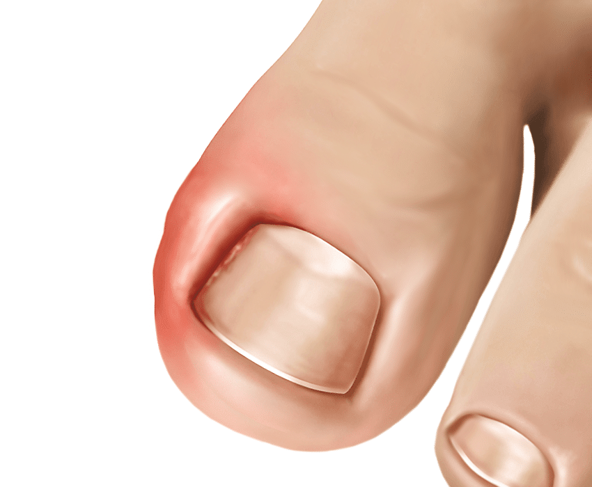 ingrown-toenail-treatment