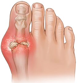 gout-pain-treatment