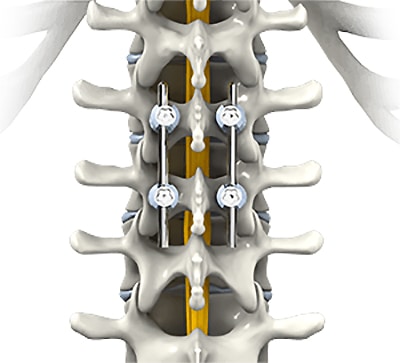 thoracic-spinal-fusion
