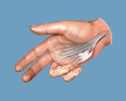 dupuytren's contracture pain relief tips