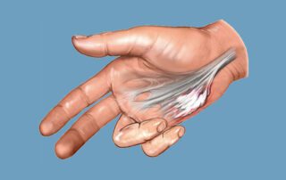 dupuytren's contracture pain relief tips