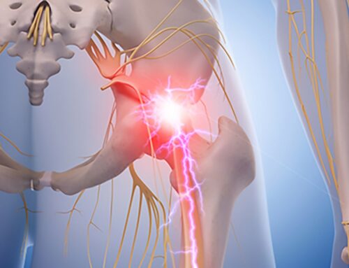 Sciatica Radiculopathy | Causes and Treatments