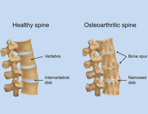 What Causes Arthritis of the Spine?