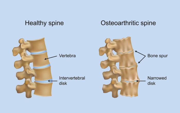 what causes arthritis of the spine