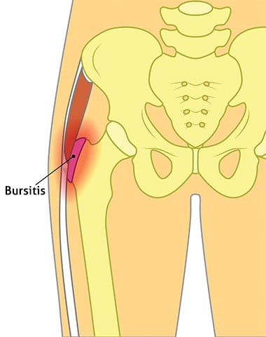 trochanteric hip bursitis