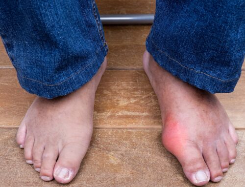 How Bunions Can Impact Your Daily Life?