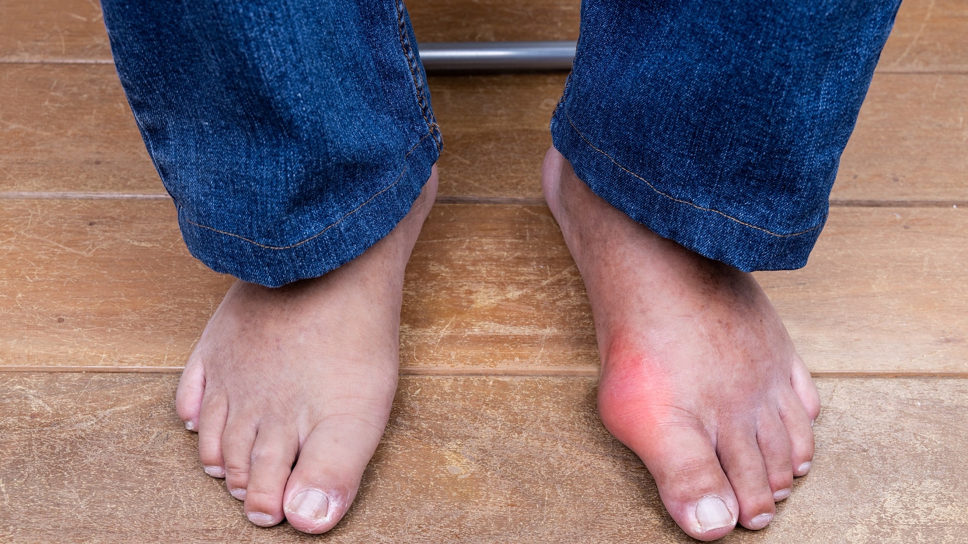 how bunions affect your life