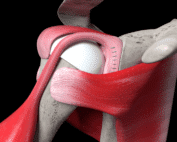 labral tear recovery