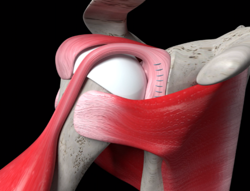 Returning to Sports and Activities After a Labral Tear: Guidelines and Considerations