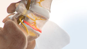 Vertebrogenic Pain Diagram